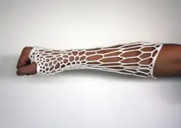 3d Printed Cast
