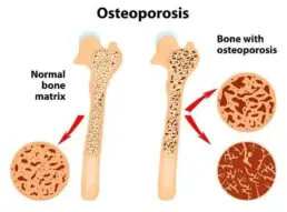 osteoporosis illustration