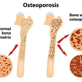 osteoporosis illustration
