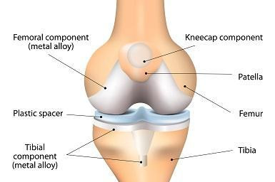 knee implant