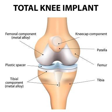 knee implant