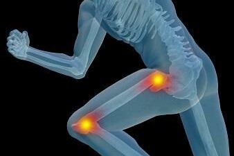 reduce arthritis pain after a knee replacement