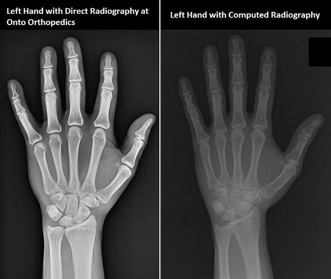 computed vs direct radiography hand quality