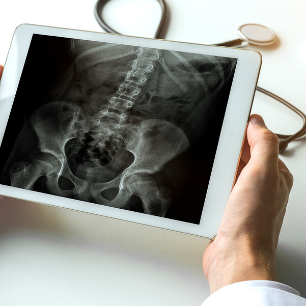 Spine Surgery X Ray Onto Orthopedics