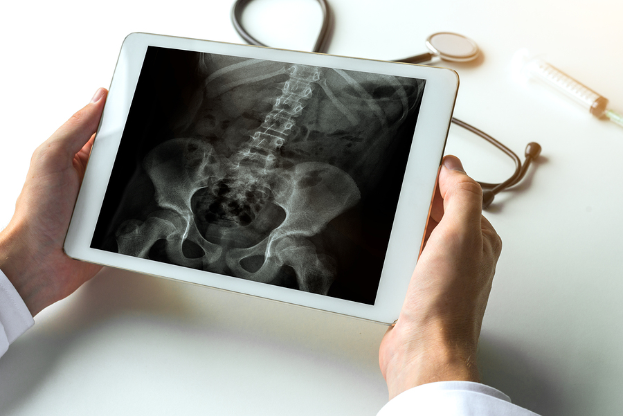 Spine Surgery X Ray Onto Orthopedics